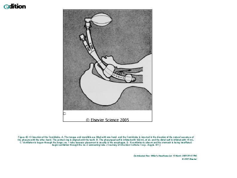 Figure 42 -13 Insertion of the Combitube. A, The tongue and mandible are lifted Figure 42 -13 Insertion of the Combitube. A, The tongue and mandible are lifted