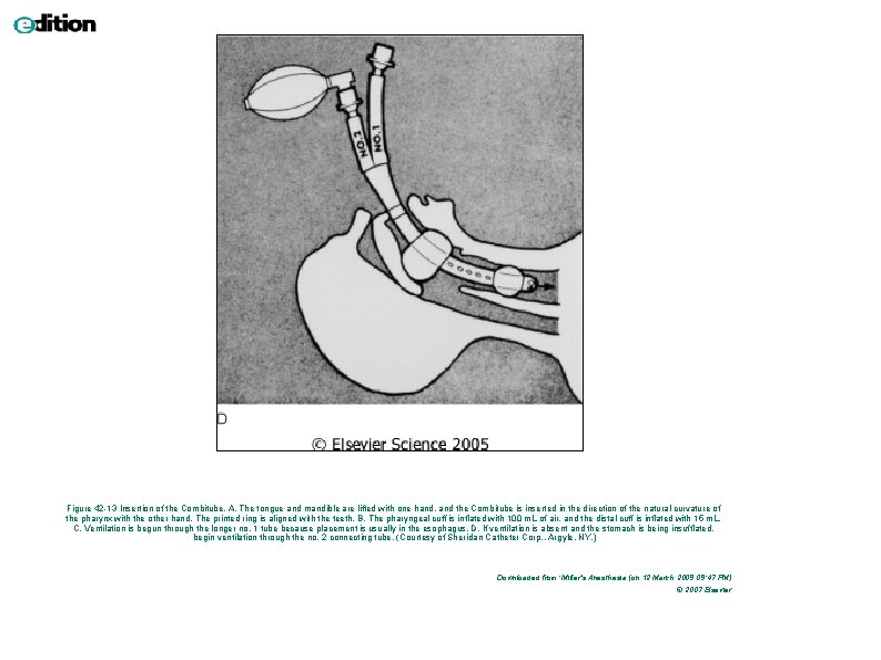 Figure 42 -13 Insertion of the Combitube. A, The tongue and mandible are lifted Figure 42 -13 Insertion of the Combitube. A, The tongue and mandible are lifted