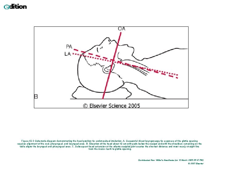 Figure 42 -3 Schematic diagram demonstrating the head position for endotracheal intubation. A, Successful Figure 42 -3 Schematic diagram demonstrating the head position for endotracheal intubation. A, Successful