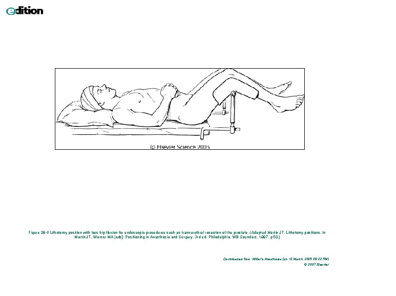 Figure 28 -4 Lithotomy position with less hip flexion for endoscopic procedures such as Figure 28 -4 Lithotomy position with less hip flexion for endoscopic procedures such as