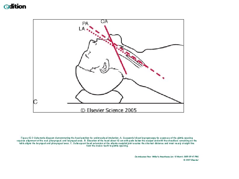 Figure 42 -3 Schematic diagram demonstrating the head position for endotracheal intubation. A, Successful Figure 42 -3 Schematic diagram demonstrating the head position for endotracheal intubation. A, Successful