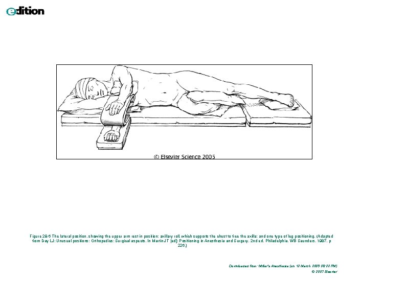 Figure 28 -6 The lateral position, showing the upper arm rest in position; axillary Figure 28 -6 The lateral position, showing the upper arm rest in position; axillary