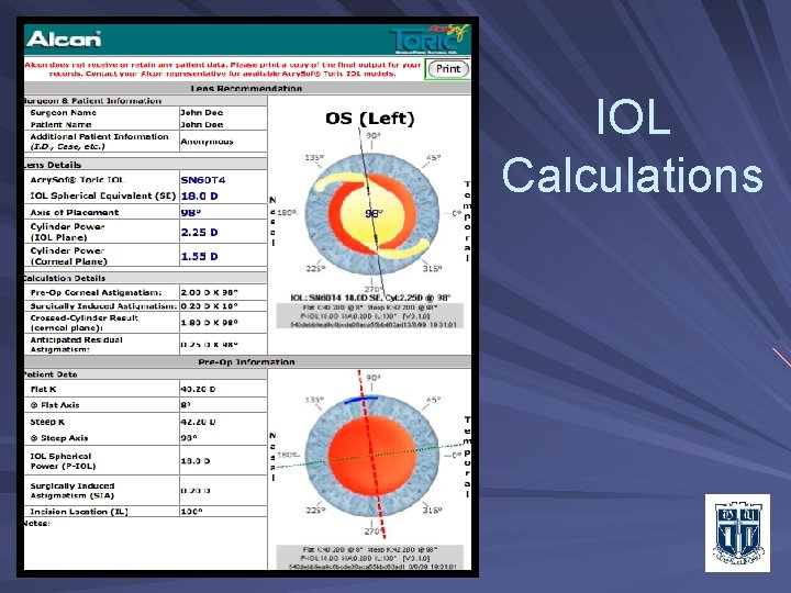 IOL Calculations 