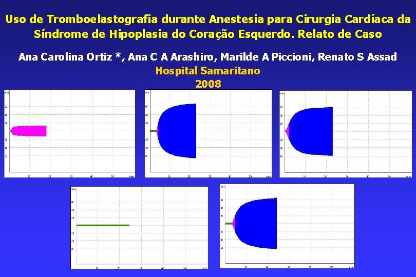 Uso de Tromboelastografia durante Anestesia para Cirurgia Cardíaca da Síndrome de Hipoplasia do Coração