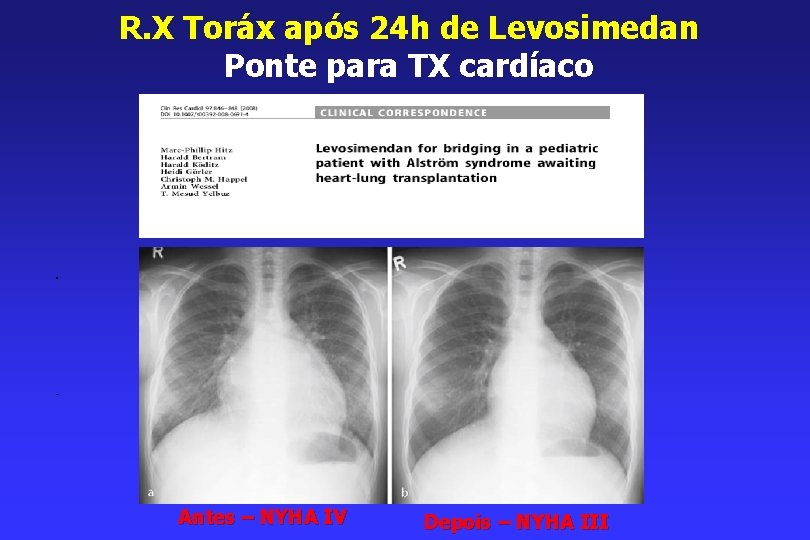 R. X Toráx após 24 h de Levosimedan Ponte para TX cardíaco Antes –