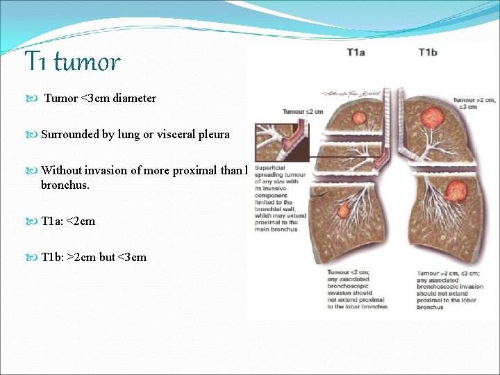 T 1 tumor Tumor <3 cm diameter Surrounded by lung or visceral pleura Without