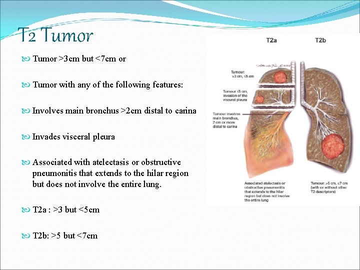 T 2 Tumor >3 cm but <7 cm or Tumor with any of the