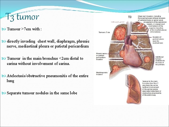 T 3 tumor Tumour >7 cm with : directly invading chest wall, diaphragm, phrenic