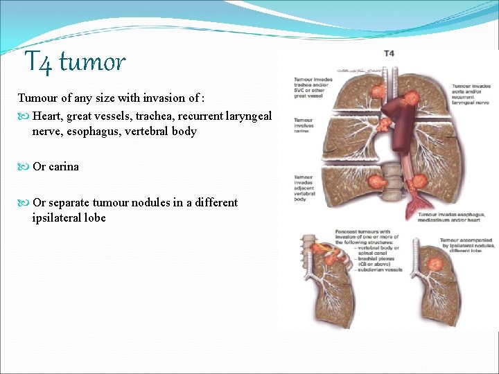 T 4 tumor Tumour of any size with invasion of : Heart, great vessels,