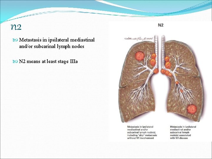 n 2 Metastasis in ipsilateral mediastinal and/or subcarinal lymph nodes N 2 means at