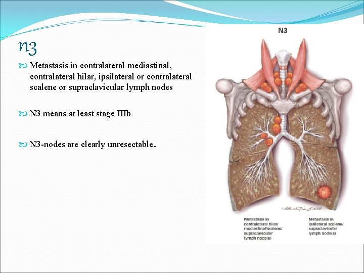 n 3 Metastasis in contralateral mediastinal, contralateral hilar, ipsilateral or contralateral scalene or supraclavicular