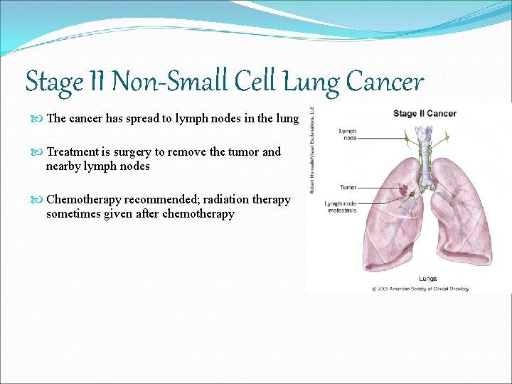 Stage II Non-Small Cell Lung Cancer The cancer has spread to lymph nodes in