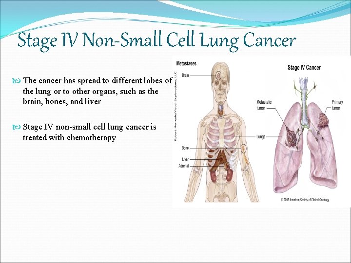 Stage IV Non-Small Cell Lung Cancer The cancer has spread to different lobes of