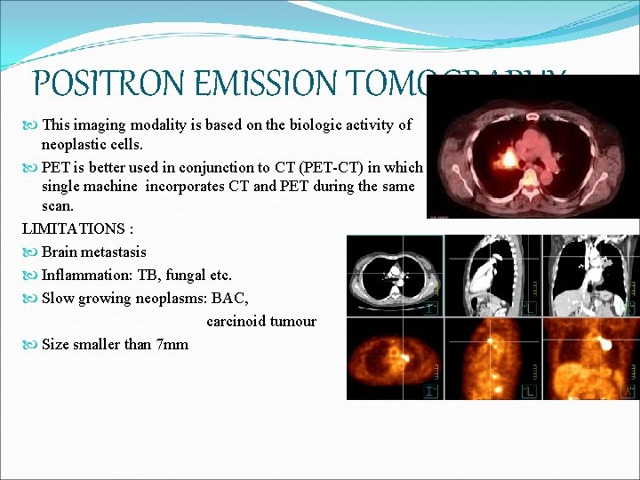 POSITRON EMISSION TOMOGRAPHY This imaging modality is based on the biologic activity of neoplastic