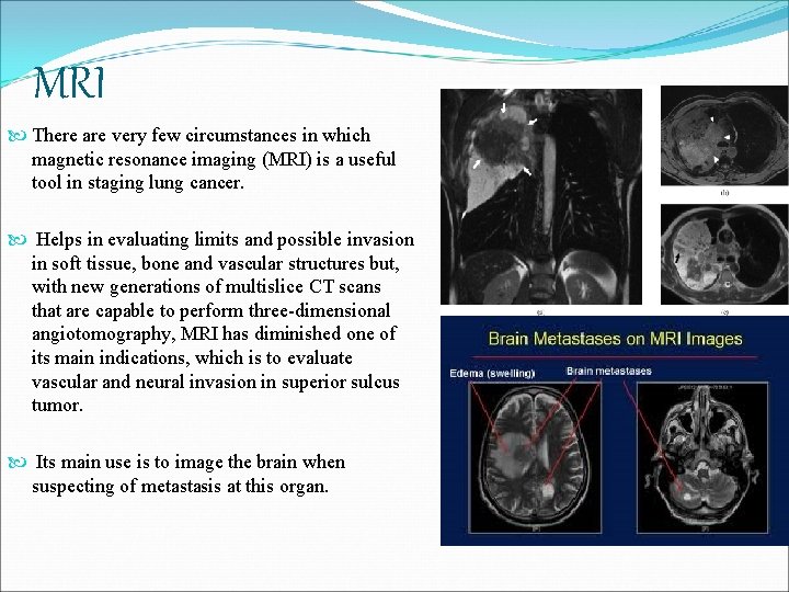 MRI There are very few circumstances in which magnetic resonance imaging (MRI) is a