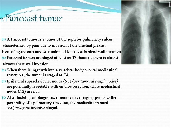 2. Pancoast tumor A Pancoast tumor is a tumor of the superior pulmonary sulcus