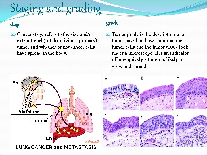 Staging and grading stage grade Cancer stage refers to the size and/or extent (reach)