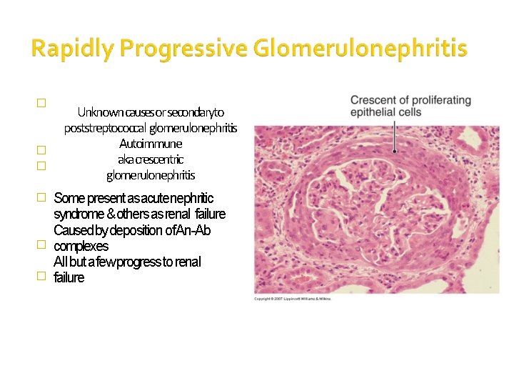 � � � Unknown causesor secondaryto poststreptococcal glomerulonephritis Autoimmune akacrescentric glomerulonephritis Some present as