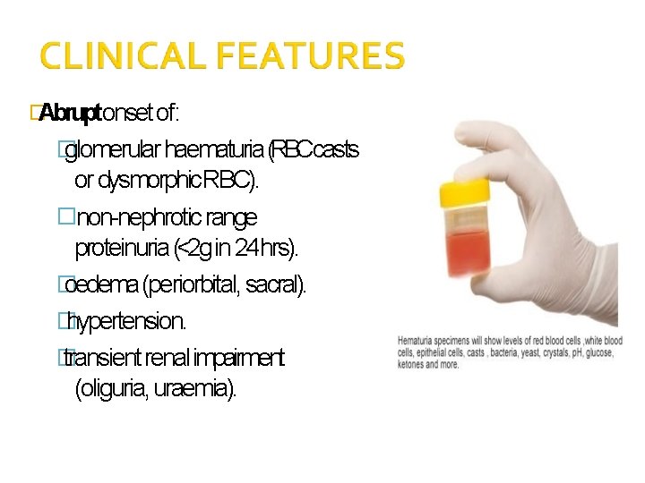 �Abruptonset of: � glomerular haematuria (RBCcasts or dysmorphic. RBC). �non-nephrotic range proteinuria (<2 g