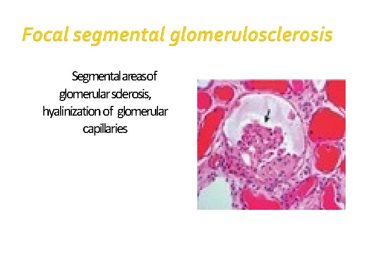 Segmentalareasof glomerular sclerosis, hyalinization of glomerular capillaries 