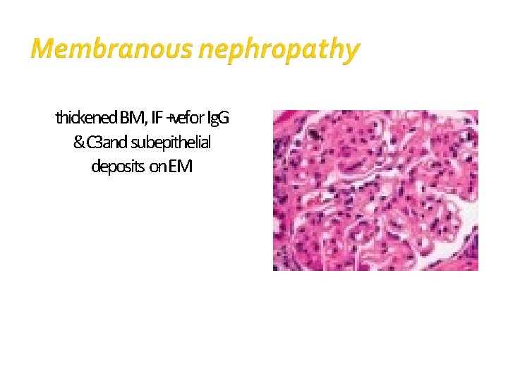 thickened BM, IF +vefor Ig. G &C 3 and subepithelial deposits on. EM 