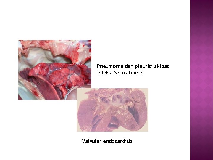 Pneumonia dan pleurisi akibat infeksi S suis tipe 2 Valvular endocarditis 