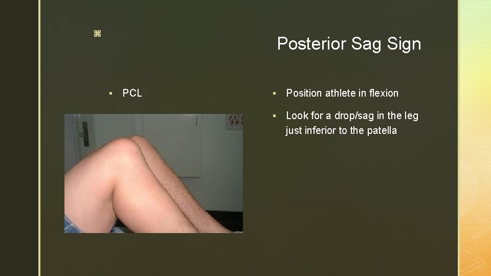 z Posterior Sag Sign § PCL § Position athlete in flexion § Look for