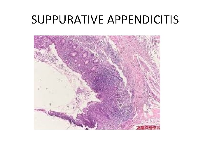 SUPPURATIVE APPENDICITIS 