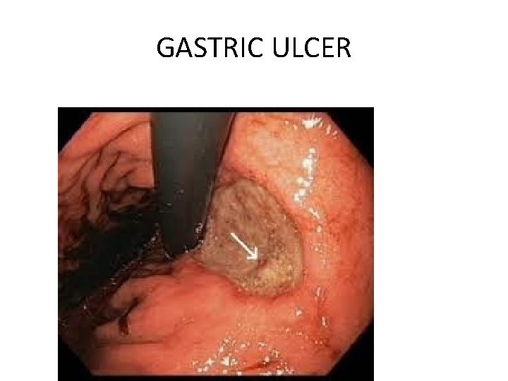 GASTRIC ULCER 