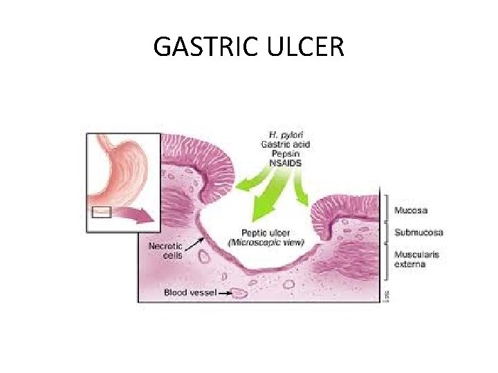 GASTRIC ULCER 