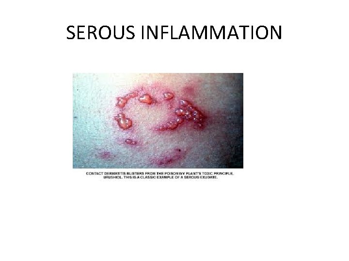 SEROUS INFLAMMATION 