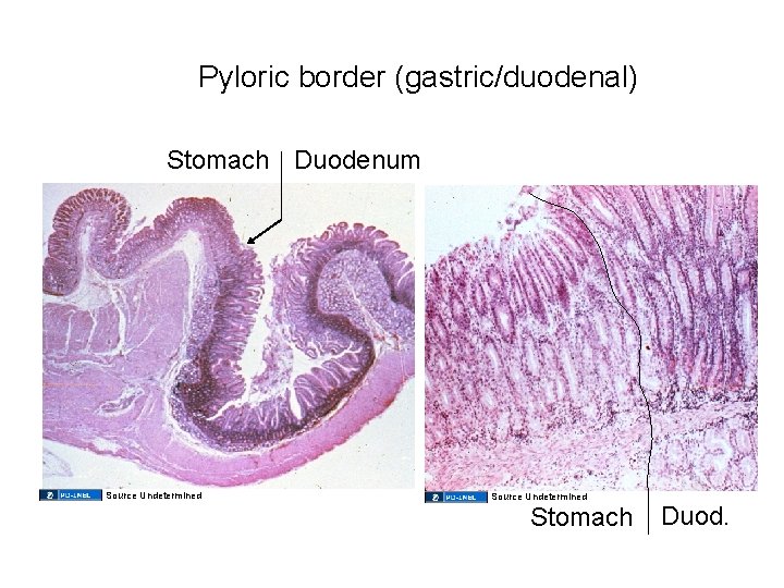 Pyloric border (gastric/duodenal) Stomach Duodenum Source Undetermined Stomach Duod. 