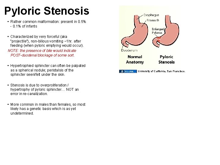 Pyloric Stenosis • Rather common malformation: present in 0. 5% - 0. 1% of
