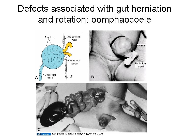 Defects associated with gut herniation and rotation: oomphaocoele Langman’s Medical Embryology, 9 th ed.