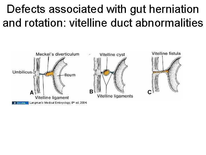 Defects associated with gut herniation and rotation: vitelline duct abnormalities Langman’s Medical Embryology, 9