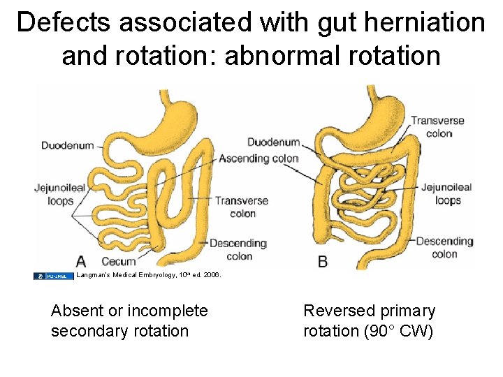 Defects associated with gut herniation and rotation: abnormal rotation Langman’s Medical Embryology, 10 th