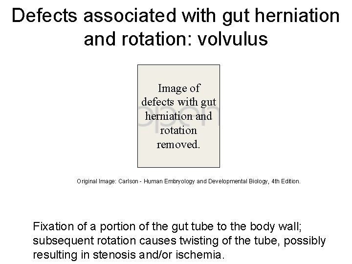 Defects associated with gut herniation and rotation: volvulus Image of defects with gut herniation