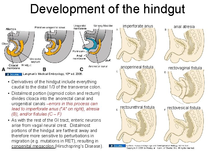 Development of the hindgut imperforate anus anal atresia anoperineal fistula rectovaginal fistula rectourethral fistula