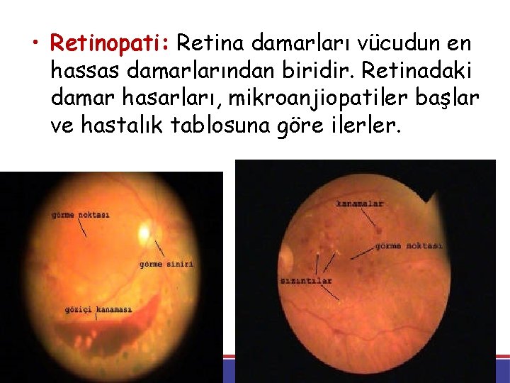  • Retinopati: Retina damarları vücudun en hassas damarlarından biridir. Retinadaki damar hasarları, mikroanjiopatiler