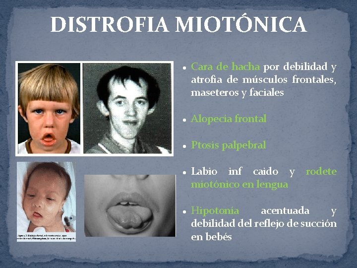 DISTROFIA MIOTÓNICA l Cara de hacha por debilidad y atrofia de músculos frontales, maseteros