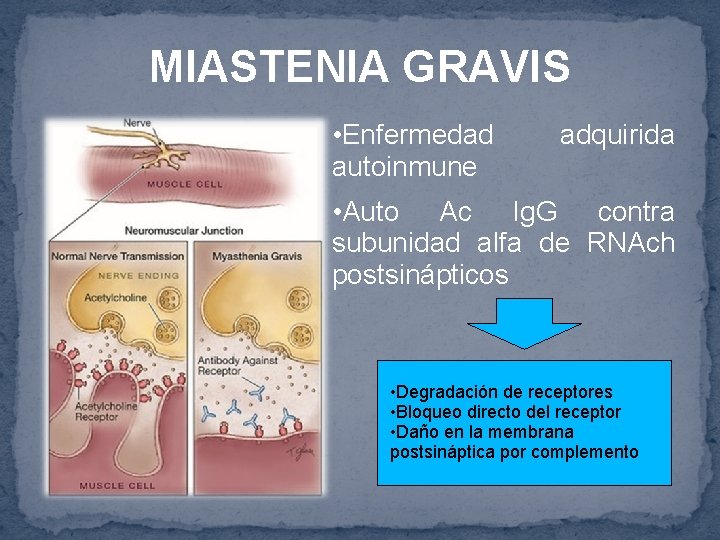 MIASTENIA GRAVIS • Enfermedad autoinmune adquirida • Auto Ac Ig. G contra subunidad alfa