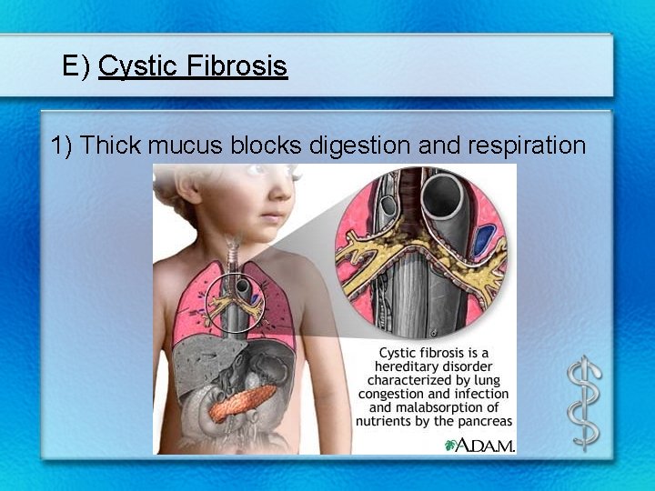 E) Cystic Fibrosis 1) Thick mucus blocks digestion and respiration 