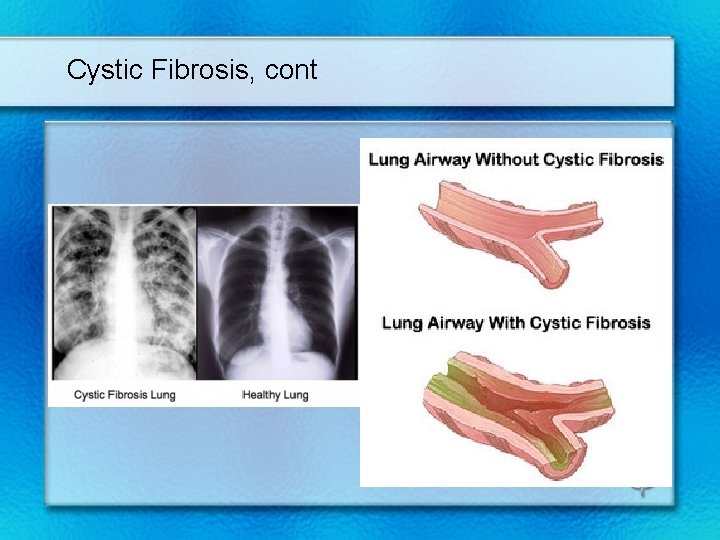 Cystic Fibrosis, cont 
