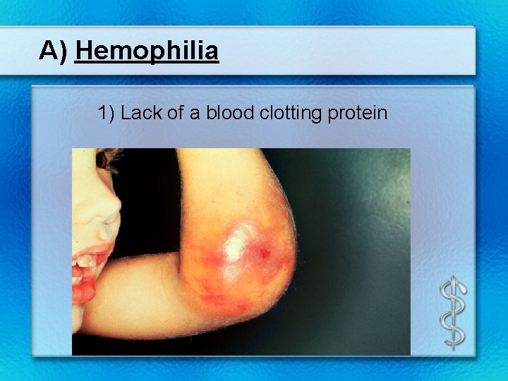 A) Hemophilia 1) Lack of a blood clotting protein 