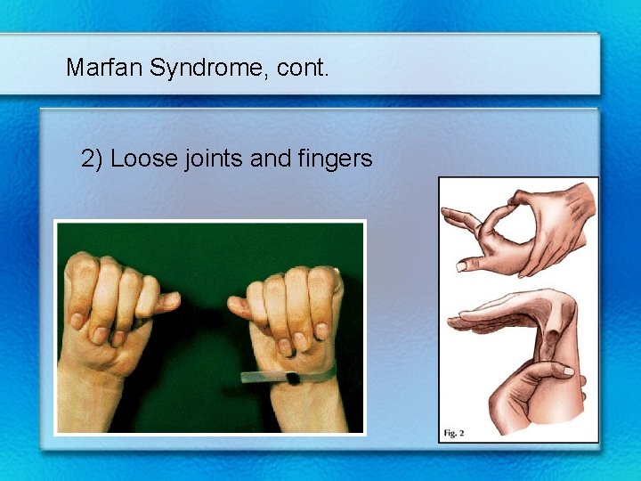 Marfan Syndrome, cont. 2) Loose joints and fingers 