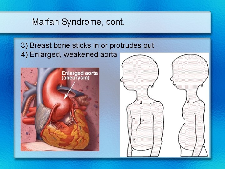 Marfan Syndrome, cont. 3) Breast bone sticks in or protrudes out 4) Enlarged, weakened