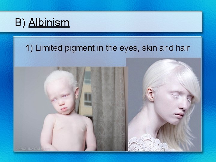 B) Albinism 1) Limited pigment in the eyes, skin and hair 