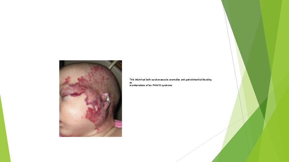 This infant had both cerebrovascular anomalies and gastrointestinal bleeding as manifestations of her PHACE