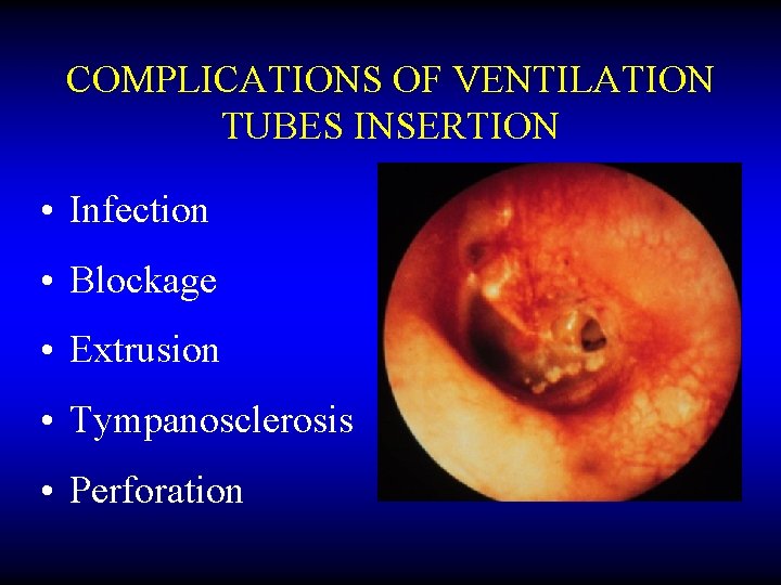 COMPLICATIONS OF VENTILATION TUBES INSERTION • Infection • Blockage • Extrusion • Tympanosclerosis •