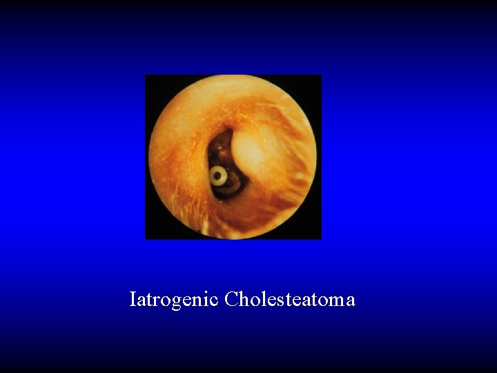 Iatrogenic Cholesteatoma 